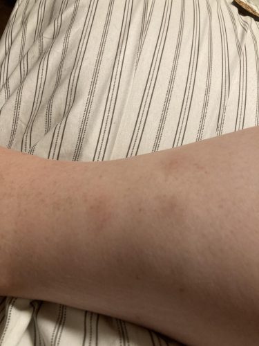 Beurer BR60 Insect Sting and Bite Relief. Bug Bite Healer for Chemical-Free Treatment of Insect Bites. Non-Toxic Natural Relief from Itching and Swelling. for Mosquito Bites photo review